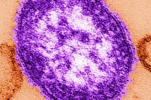 Connecticut reports first measles case of 2026