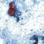 Michigan reports the first 2 US deaths related to a diarrhea-causing parasite